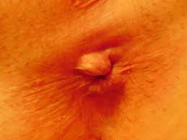 Признаки геморроя у девушек и женщин Признаки геморроя у девушек и женщин