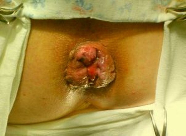 Признаки геморроя у девушек и женщин Признаки геморроя у девушек и женщин