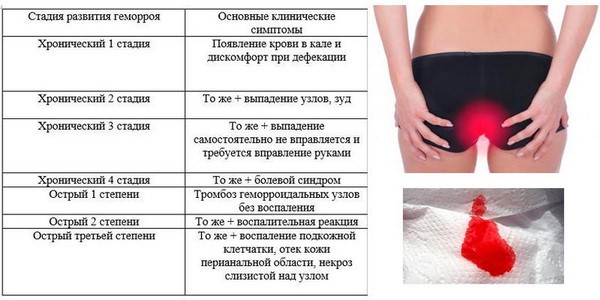 Признаки геморроя у девушек и женщин Признаки геморроя у девушек и женщин