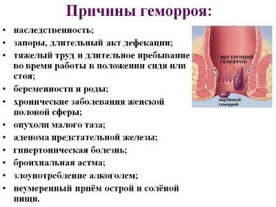 Признаки геморроя у девушек и женщин Признаки геморроя у девушек и женщин