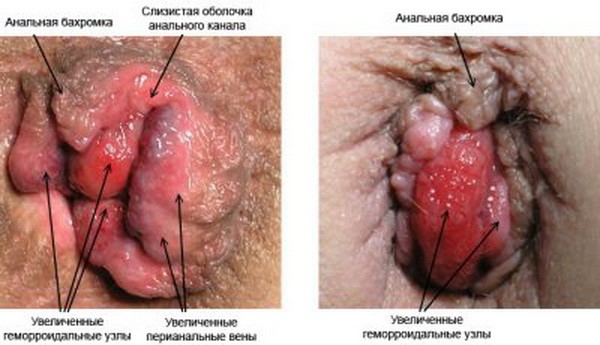 Признаки геморроя у девушек и женщин Признаки геморроя у девушек и женщин