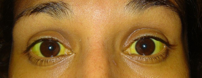 Все о гепатите С: течение недуга, методы терапии Все о гепатите С: течение недуга, методы терапии