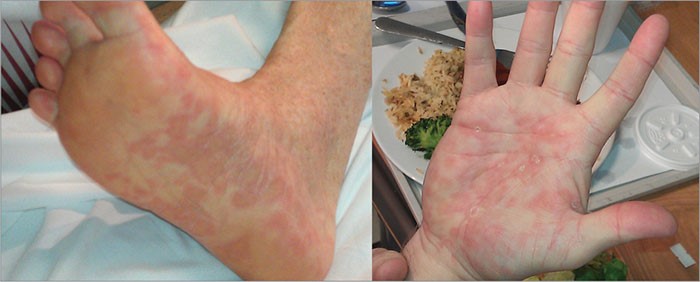 Все о гепатите С: течение недуга, методы терапии Все о гепатите С: течение недуга, методы терапии