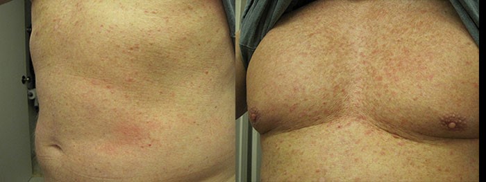 Все о гепатите С: течение недуга, методы терапии Все о гепатите С: течение недуга, методы терапии