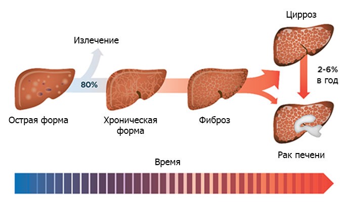 Все о гепатите С: течение недуга, методы терапии Все о гепатите С: течение недуга, методы терапии