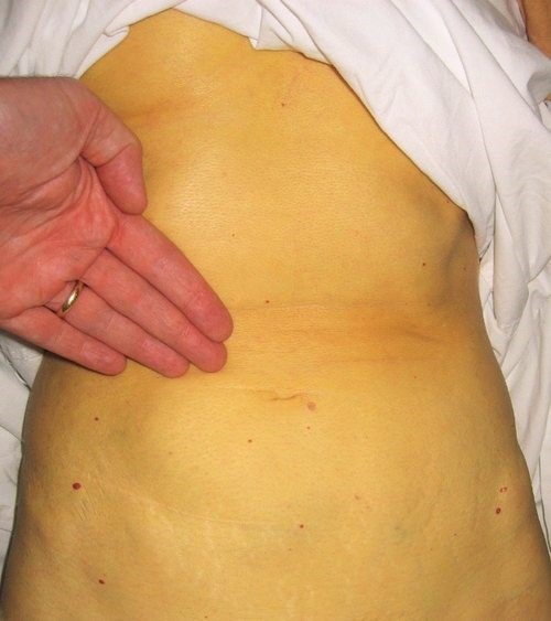 Специфика проявления гепатита В у женщин Специфика проявления гепатита В у женщин