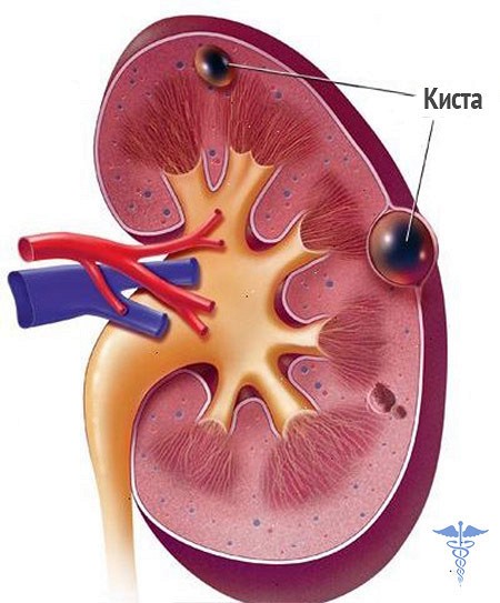Кистозная трансформация почек приводит к хронической почечной недостаточности Кистозная трансформация почек приводит к хронической почечной недостаточности