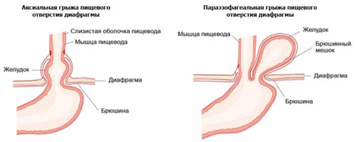 Симптомы грыжи желудка и лечение народными средствами Симптомы грыжи желудка и лечение народными средствами