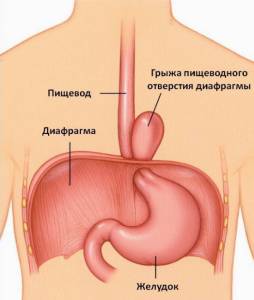 Симптомы грыжи желудка и лечение народными средствами Симптомы грыжи желудка и лечение народными средствами
