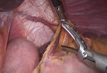 Симптомы грыжи желудка и лечение народными средствами Симптомы грыжи желудка и лечение народными средствами