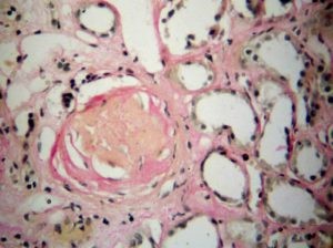 Инфаркт: некротическое поражение почек Инфаркт: некротическое поражение почек