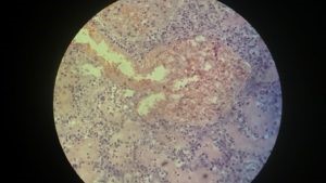 Инфаркт: некротическое поражение почек Инфаркт: некротическое поражение почек