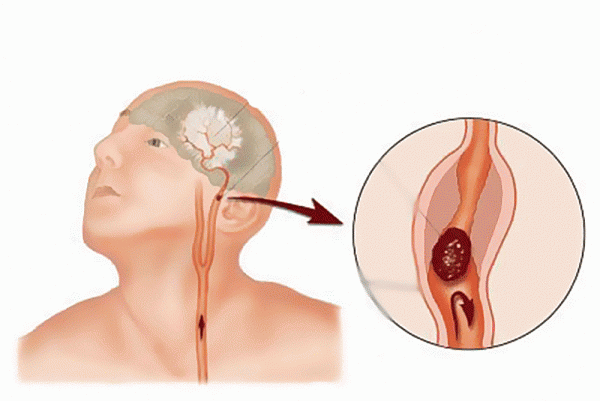 Причины инсульта головного мозга Причины инсульта головного мозга
