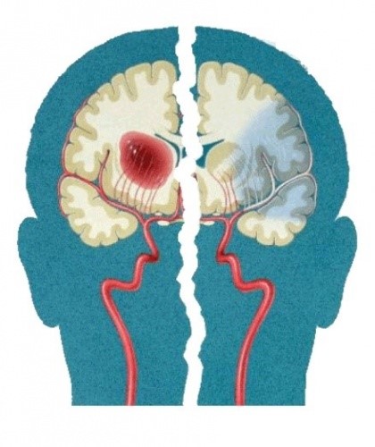 Причины инсульта головного мозга Причины инсульта головного мозга