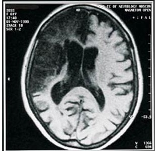 Левосторонний ишемический инсульт и его последствия Левосторонний ишемический инсульт и его последствия