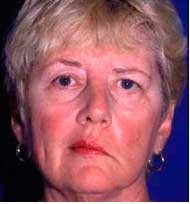 Левосторонний ишемический инсульт и его последствия Левосторонний ишемический инсульт и его последствия