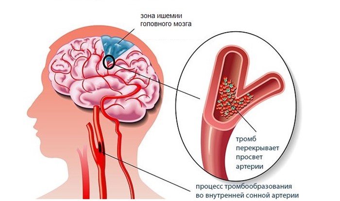 Ишемическая болезнь головного мозга: почему возникает, эффект от лечения Ишемическая болезнь головного мозга: почему возникает, эффект от лечения