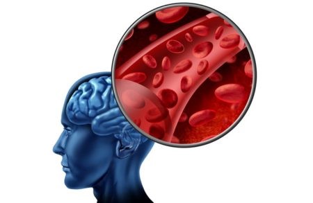 Ишемическая болезнь головного мозга: почему возникает, эффект от лечения Ишемическая болезнь головного мозга: почему возникает, эффект от лечения