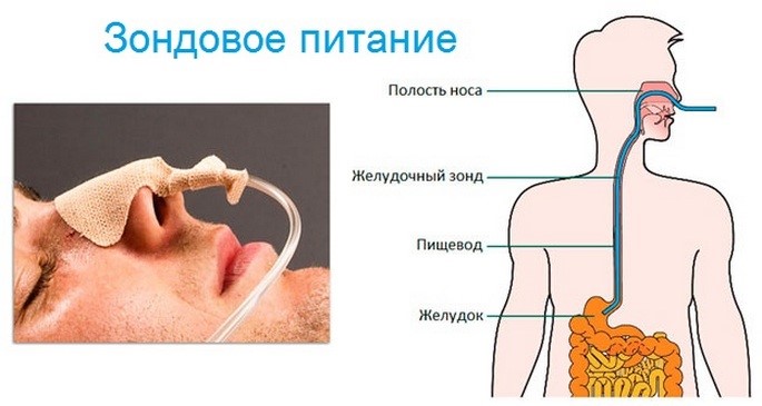Ишемическая болезнь головного мозга: почему возникает, эффект от лечения Ишемическая болезнь головного мозга: почему возникает, эффект от лечения