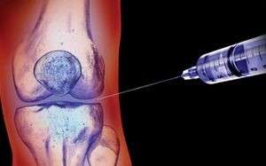 Препараты и уколы от артроза коленного сустава Препараты и уколы от артроза коленного сустава