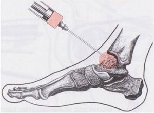Препараты и уколы от артроза коленного сустава Препараты и уколы от артроза коленного сустава