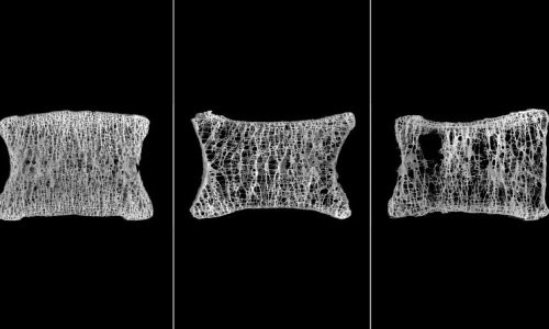 Лучшие методы лечения остеопороза у пожилых женщин Лучшие методы лечения остеопороза у пожилых женщин