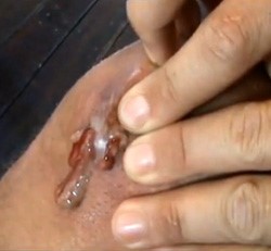 Лечение синовита коленного сустава в домашних условиях Лечение синовита коленного сустава в домашних условиях