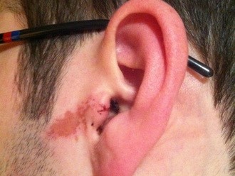 Трахеобронхит: различие симптомов у взрослых и детей Трахеобронхит: различие симптомов у взрослых и детей