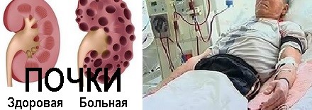 Какие препараты при почечной недостаточности самые эффективные? Какие препараты при почечной недостаточности самые эффективные?