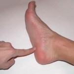 Как снять боль при пяточной шпоре: как лечить если болит пятка Как снять боль при пяточной шпоре: как лечить если болит пятка