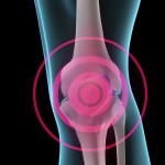 Как снять боль при пяточной шпоре: как лечить если болит пятка Как снять боль при пяточной шпоре: как лечить если болит пятка