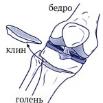 Как снять боль при пяточной шпоре: как лечить если болит пятка Как снять боль при пяточной шпоре: как лечить если болит пятка