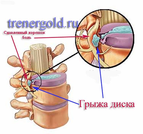 Гиперэкстензия при межпозвоночных грыжах Гиперэкстензия при межпозвоночных грыжах