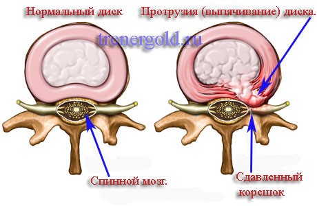 Гиперэкстензия при межпозвоночных грыжах Гиперэкстензия при межпозвоночных грыжах