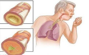 Способы, как вывести мокроту из бронхов Способы, как вывести мокроту из бронхов
