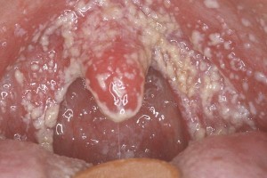 Опасен ли белый налет на гортани? Опасен ли белый налет на гортани?