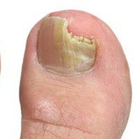 Симптомы и лечение кандидоза пищевода Симптомы и лечение кандидоза пищевода