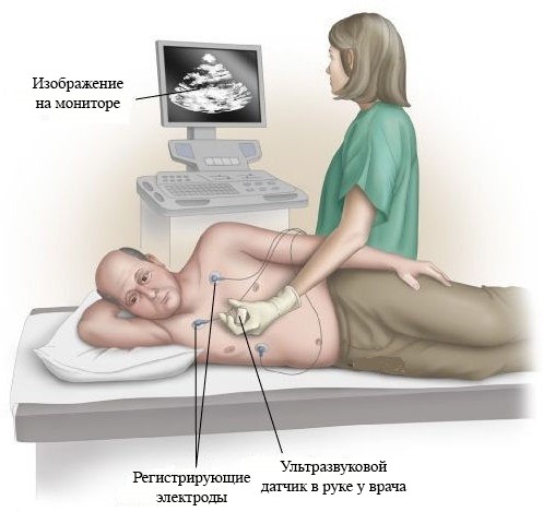 Кардиосклероз диффузной формы: классификация, диагностика и лечение Кардиосклероз диффузной формы: классификация, диагностика и лечение