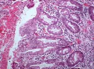 Метаплазия желудка Метаплазия желудка