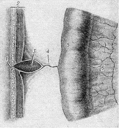 Свищи в кишечнике Свищи в кишечнике