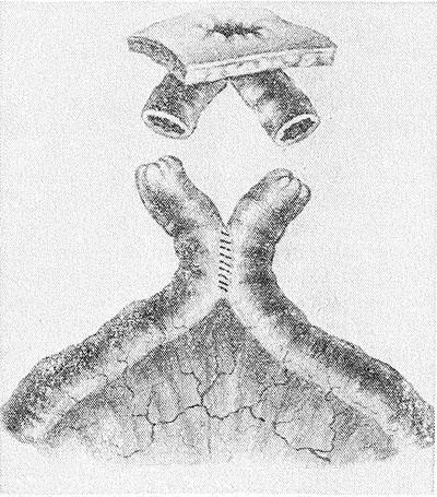 Свищи в кишечнике Свищи в кишечнике