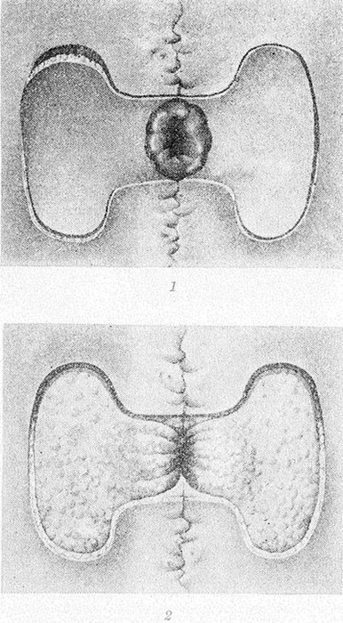 Свищи в кишечнике Свищи в кишечнике