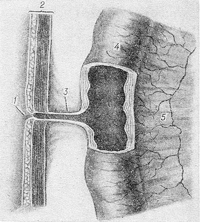 Свищи в кишечнике Свищи в кишечнике