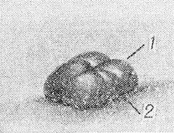 Свищи в кишечнике Свищи в кишечнике