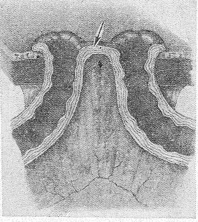 Свищи в кишечнике Свищи в кишечнике