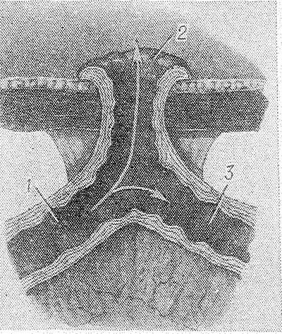 Свищи в кишечнике Свищи в кишечнике