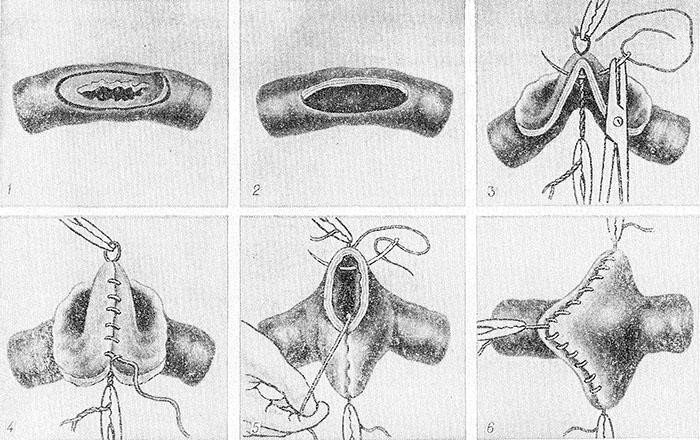 Свищи в кишечнике Свищи в кишечнике
