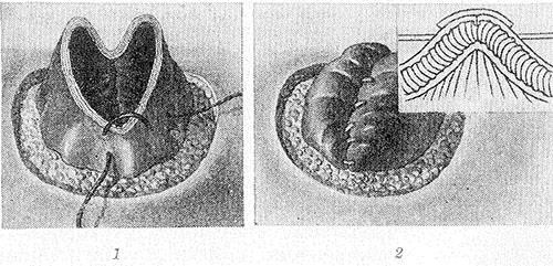 Свищи в кишечнике Свищи в кишечнике