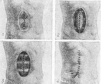 Свищи в кишечнике Свищи в кишечнике