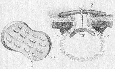 Свищи в кишечнике Свищи в кишечнике